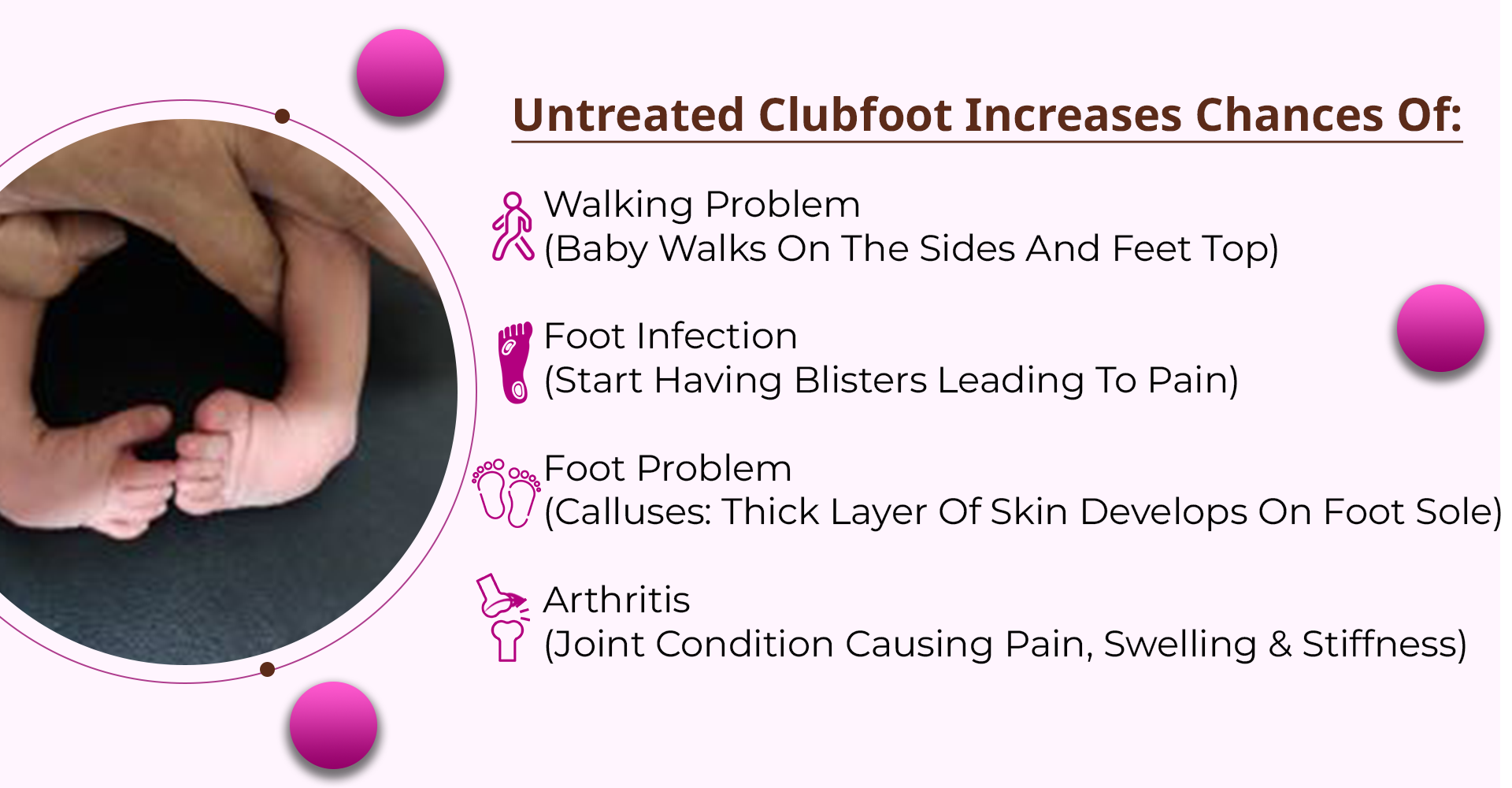 Clubfoot Deformity: Common Birth Defect